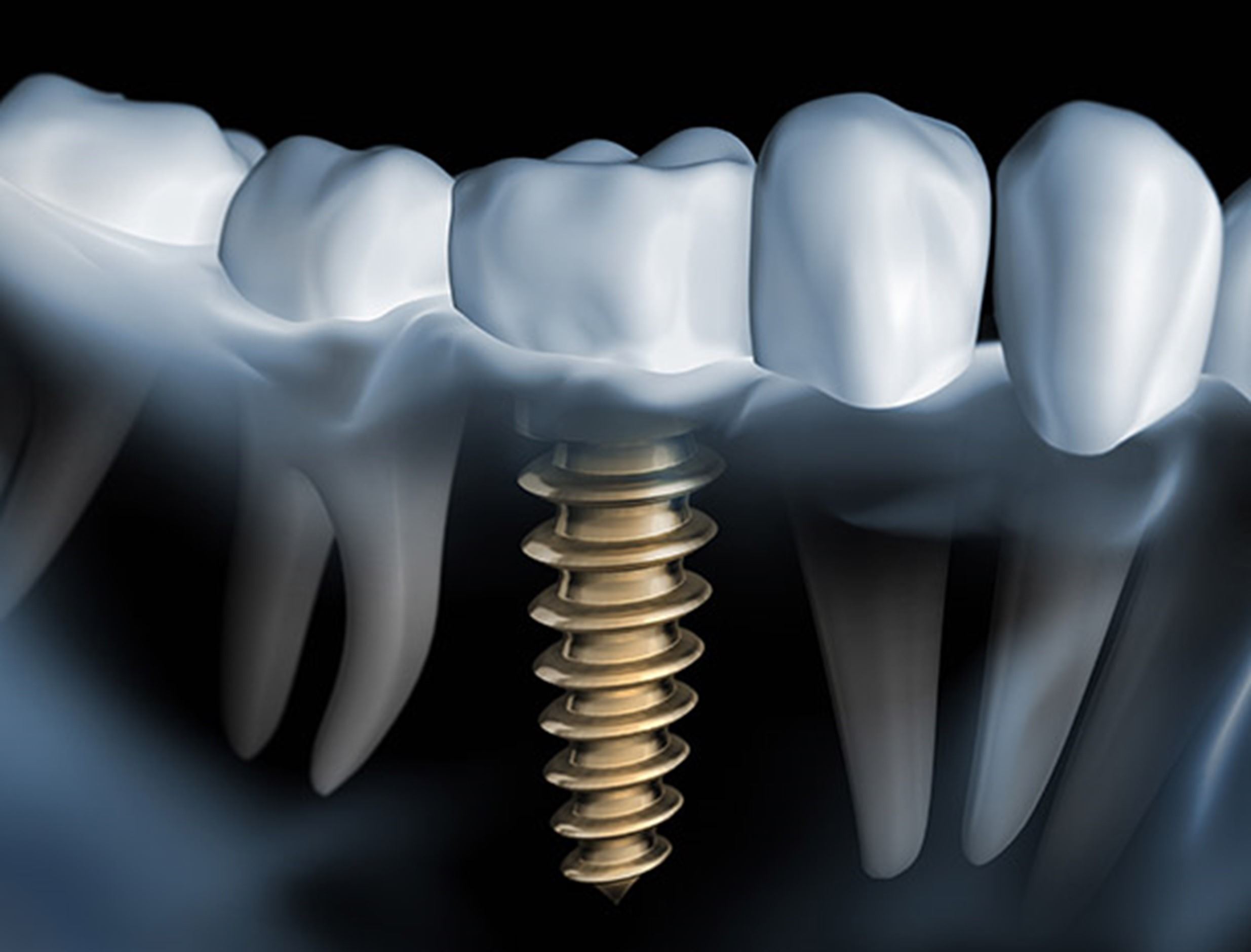 Tratamiento de implantologia - Clinica dental San Lorenzo